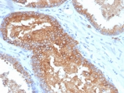 IHC staining of FFPE human prostate carcinoma tissue with CD38 antibody (clone CD38/4328) at 2ug/ml in PBS for 30min RT. Strong cytoplasmic and membranous staining observed . HIER: boil tissue sections in pH 9 10mM Tris with 1mM EDTA for 20 min and allow to cool before testing.