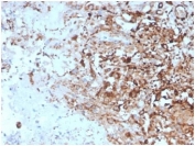 IHC staining of FFPE human lymph node with TIM-3 antibody (clone TIM3/4027). HIER: boil tissue sections in pH 9 10mM Tris with 1mM EDTA for 20 min and allow to cool before testing.