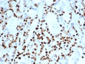 IHC staining of FFPE human ovarian carcinoma tissue with recombinant CCNE1 antibody (clone CCNE1/4935R). HIER: boil tissue sections in pH 9 10mM Tris with 1mM EDTA for 20 min and allow to cool before testing.