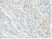 IHC staining of FFPE human colon tissue from a patient with Lynch syndrome using recombinant MSH6 antibody (clone MSH6/6654R). HIER: boil tissue sections in pH 9 10mM Tris with 1mM EDTA for 20 min and allow to cool before testing.