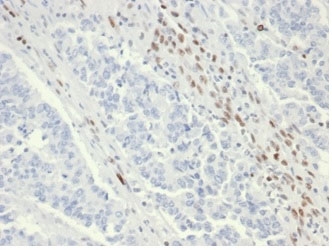 IHC staining of FFPE human colon tissue from a patient with Lynch syndrome using recombinant MSH6 antibody (clone MSH6/6654R). HIER: boil tissue sections in pH 9 10mM Tris with 1mM EDTA for 20 min and allow to cool before testing.