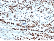 IHC staining of FFPE human colon carcinoma tissue with recombinant MSH6 antibody (clone MSH6/6654R). HIER: boil tissue sections in pH 9 10mM Tris with 1mM EDTA for 20 min and allow to cool before testing.