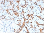 IHC staining of FFPE human kidney adenocarcinoma tissue with Collagen IV antibody (clone M3F7) at 2ug/ml in PBS for 30min RT. Strong staining of glomeruli is observed. Negative control inset: PBS instead of primary antibody to control for secondary binding. HIER: boil tissue sections in pH 9 10mM Tris with 1mM EDTA for 20 min and allow to cool before testing.