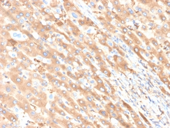 IHC staining of FFPE human liver carcinoma in colon tissue with ALB antibody (clone ALB/6411R). HIER: boil tissue sections in pH 9 10mM Tris with 1mM EDTA for 20 min and allow to cool before testing.~