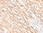 IHC staining of FFPE human liver carcinoma in colon tissue with Albumin antibody (clone ALB/6411R). HIER: boil tissue sections in pH 9 10mM Tris with 1mM EDTA for 20 min and allow to cool before testing.
