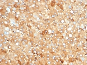 IHC staining of FFPE human liver carcinoma in colon with recombinant Albumin antibody (clone rALB/6412). HIER: boil tissue sections in pH 9 10mM Tris with 1mM EDTA for 20 min and allow to cool before testing.