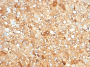 IHC staining of FFPE human liver carcinoma in colon with recombinant Albumin antibody (clone rALB/6412). HIER: boil tissue sections in pH 9 10mM Tris with 1mM EDTA for 20 min and allow to cool before testing.