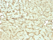 IHC staining of FFPE human liver carcinoma in colon tissue with Albumin antibody (clone rALB/6412). HIER: boil tissue sections in pH 9 10mM Tris with 1mM EDTA for 20 min and allow to cool before testing.