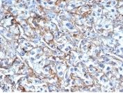 IHC staining of FFPE human renal cell carcinoma tissue with ICAM-1 antibody (clone ICAM1/6319). HIER: boil tissue sections in pH 9 10mM Tris with 1mM EDTA for 20 min and allow to cool before testing.