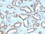 IHC staining of FFPE human prostate tissue with NKX3.1 antibody (clone NKX3.1/4562R). HIER: boil tissue sections in pH 9 10mM Tris with 1mM EDTA for 20 min and allow to cool before testing.
