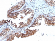 IHC staining of FFPE human prostate carcinoma tissue with recombinant TMEPAI antibody (clone PMEPA1/6421R). HIER: boil tissue sections in pH 9 10mM Tris with 1mM EDTA for 20 min and allow to cool before testing.