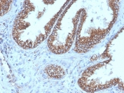 IHC staining of FFPE human prostate carcinoma tissue with recombinant TMEPA1 antibody (clone PMEPA1/6421R). HIER: boil tissue sections in pH 9 10mM Tris with 1mM EDTA for 20 min and allow to cool before testing.