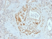 IHC staining of FFPE human breast tissue with HOMEZ antibody (clone PCRP-HOMEZ-1B5). HIER: boil tissue sections in pH 9 10mM Tris with 1mM EDTA for 20 min and allow to cool before testing.