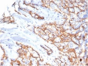 IHC staining of FFPE human papillary renal cell carcinoma tissue with CD133 antibody (clone PROM/6316). HIER: boil tissue sections in pH 9 10mM Tris with 1mM EDTA for 20 min and allow to cool before testing.