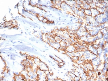IHC staining of FFPE human papillary renal cell carcinoma tissue with CD133 antibody (clone PROM/6316). HIER: boil tissue sections in pH 9 10mM Tris with 1mM EDTA for 20 min and allow to cool before testing.