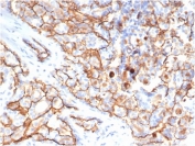 IHC staining of FFPE human papillary renal cell carcinoma tissue with CD133 antibody (clone PROM/6316). HIER: boil tissue sections in pH 9 10mM Tris with 1mM EDTA for 20 min and allow to cool before testing.