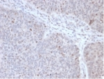 IHC staining of FFPE human lymphoma tissue with POLE3 antibody (clone PCRP-POLE3-2F10) at 2ug/ml. HIER: boil tissue sections in pH 9 10mM Tris with 1mM EDTA for 20 min and allow to cool before testing.
