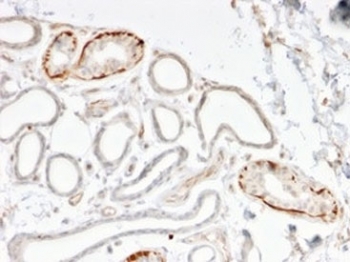 IHC staining of FFPE human breast carcinoma tissue with GTF2H2C antibody (clone PCRP-GTF2H2C-2C9). HIER: boil tissue sections in pH 9 10mM Tris with 1mM EDTA for 20 min and allow to cool before testing.