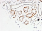 IHC staining of FFPE human breast carcinoma tissue with GTF2H2C antibody (clone PCRP-GTF2H2C-2C9). HIER: boil tissue sections in pH 9 10mM Tris with 1mM EDTA for 20 min and allow to cool before testing.