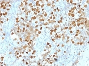 IHC staining of FFPE human breast carcinoma tissue with ZMYM3 antibody (clone PCRP-ZMYM3-2F10). HIER: boil tissue sections in pH 9 10mM Tris with 1mM EDTA for 20 min and allow to cool before testing.