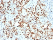 IHC staining of FFPE human lymph node tissue with recombinant Ki-67 antibody (clone MKI67/4945R). HIER: boil tissue sections in pH 9 10mM Tris with 1mM EDTA for 20 min and allow to cool before testing.