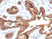 IHC staining of FFPE human breast carcinoma tissue with recombinant Mucin-1 antibody (clone MUC1/4416R). HIER: boil tissue sections in pH 9 10mM Tris with 1mM EDTA for 20 min and allow to cool before testing.