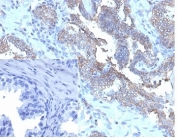 IHC staining of FFPE human prostate carcinoma tissue with recombinant CD47 antibody (clone CD47/6362R). HIER: boil tissue sections in pH 9 10mM Tris with 1mM EDTA for 20 min and allow to cool before testing.