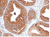 IHC staining of FFPE human prostate carcinoma tissue with recombinant CD47 antibody (clone CD47/6362R). Negative control inset: PBS used instead of primary antibody to control for secondary Ab binding. HIER: boil tissue sections in pH 9 10mM Tris with 1mM EDTA for 20 min and allow to cool before testing.
