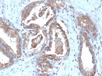 IHC staining of FFPE human prostate carcinoma tissue with recombinant CD47 antibody (clone CD47/6364R). HIER: boil tissue sections in pH 9 10mM Tris with 1mM EDTA for 20 min and allow to cool before testing.~