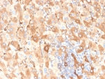 IHC staining of FFPE human liver carcinoma in colon with recombinant Albumin antibody (clone ALB/6409R). HIER: boil tissue sections in pH 9 10mM Tris with 1mM EDTA for 20 min and allow to cool before testing.