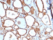 IHC staining of FFPE human thyroid with recombinant HSP27 antibody (clone HSPB1/6490R). HIER: boil tissue sections in pH 9 10mM Tris with 1mM EDTA for 20 min and allow to cool before testing.