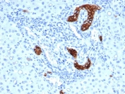 IHC staining of FFPE human colorectal liver metastasis with recombinant TACSTD2 antibody (clone rTACSTD2/6397). HIER: boil tissue sections in pH 9 10mM Tris with 1mM EDTA for 20 min and allow to cool before testing.