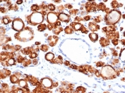 IHC staining of FFPE human thyroid carcinoma tissue with recombinant TPO antibody (clone TPO/6417R). HIER: boil tissue sections in pH 9 10mM Tris with 1mM EDTA for 20 min and allow to cool before testing.