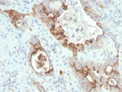 IHC staining of FFPE human colon carcinoma tissue with recombinant PMEPA1 (clone rPMEPA1/6422). HIER: boil tissue sections in pH 9 10mM Tris with 1mM EDTA for 20 min and allow to cool before testing.