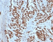 IHC staining of FFPE human colon tissue with recombinant MSH2 antibody (clone rMSH2/6548). HIER: boil tissue sections in pH 9 10mM Tris with 1mM EDTA for 20 min and allow to cool before testing.