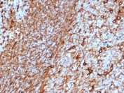 IHC staining of FFPE human tonsil tissue with Vimentin antibody (clone rVIM/6575). HIER: boil tissue sections in pH 9 10mM Tris with 1mM EDTA for 20 min and allow to cool before testing.