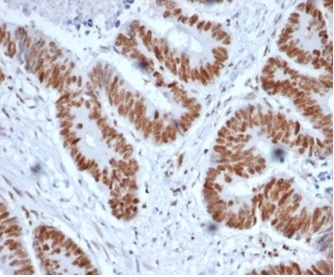 IHC staining of FFPE human colon tissue with MSH2 antibody (clone MSH2/6852). HIER: boil tissue sections in pH 9 10mM Tris with 1mM EDTA for 20 min and allow to cool before testing.