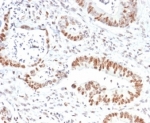 IHC staining of FFPE human colon tissue with MSH2 antibody (clone MSH2/6852). HIER: boil tissue sections in pH 9 10mM Tris with 1mM EDTA for 20 min and allow to cool before testing.