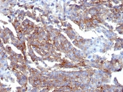 IHC staining of FFPE human breast tissue with recombinant CD44 antibody (clone HCAM/6459R). HIER: boil tissue sections in pH 9 10mM Tris with 1mM EDTA for 20 min and allow to cool before testing.