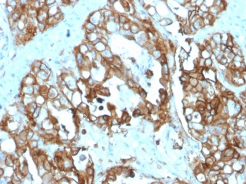 IHC staining of FFPE human colon carcinoma tissue with recombinant TROP2 antibody (clone rTACSTD2/6395). HIER: boil tissue sections in pH 9 10mM Tris with 1mM EDTA for 20 min and allow to cool before testing.