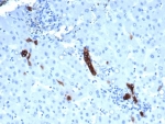 IHC staining of FFPE human colorectal liver metastasis with recombinant TROP2 antibody (clone rTACSTD2/6395). HIER: boil tissue sections in pH 9 10mM Tris with 1mM EDTA for 20 min and allow to cool before testing.