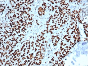 IHC staining of FFPE human colon tissue with MSH2 antibody (clone MSH2/6549R). HIER: boil tissue sections in pH 9 10mM Tris with 1mM EDTA for 20 min and allow to cool before testing.