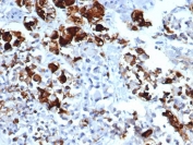 IHC staining of FFPE human pituitary tissue with recombinant PRL antibody (clone rPRL/4909). HIER: boil tissue sections in pH 9 10mM Tris with 1mM EDTA for 20 min and allow to cool before testing.