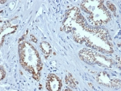 IHC staining of FFPE human prostate tissue with recombinant AMACR antibody (clone rAMACR/6369). HIER: boil tissue sections in pH 9 10mM Tris with 1mM EDTA for 20 min and allow to cool before testing.