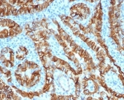 IHC staining of FFPE human thyroid carcinoma tissue with recombinant TROP2 antibody (clone TACSTD2/6396R). HIER: boil tissue sections in pH 9 10mM Tris with 1mM EDTA for 20 min and allow to cool before testing.