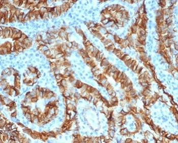 IHC staining of FFPE human thyroid carcinoma tissue with recombinant TROP2 antibody (clone TACSTD2/6396R). HIER: boil tissue sections in pH 9 10mM Tris with 1mM EDTA for 20 min and allow to cool before testing.