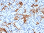 IHC staining of FFPE human colorectal liver metastasis with TACSTD2 antibody (clone TACSTD2/6394R). HIER: boil tissue sections in pH 9 10mM Tris with 1mM EDTA for 20 min and allow to cool before testing.