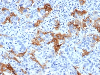 IHC staining of FFPE human colorectal liver metastasis with TACSTD2 antibody (clone TACSTD2/6394R). HIER: boil tissue sections in pH 9 10mM Tris with 1mM EDTA for 20 min and allow to cool before testing.