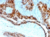 IHC staining of FFPE human thyroid carcinoma tissue with TACSTD2 antibody (clone TACSTD2/6394R). HIER: boil tissue sections in pH 9 10mM Tris with 1mM EDTA for 20 min and allow to cool before testing.
