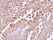 IHC staining of FFPE human colon tissue with recombinant Carcinoembryonic Antigen antibody (clone C66/6470R). HIER: boil tissue sections in pH 9 10mM Tris with 1mM EDTA for 20 min and allow to cool before testing.
